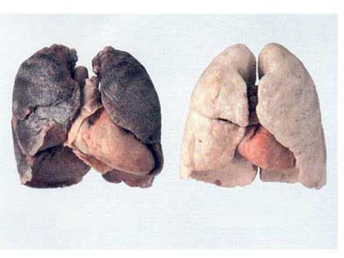 hội chứng của bệnh ung thư phổi