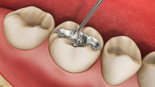 Trám răng từ 8 lần làm tăng nồng độ thủy ngân trong máu
