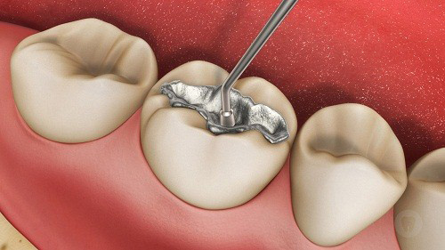 Những vết trám răng sẽ làm tổn hại rất lớn đến sức khỏe của bạn